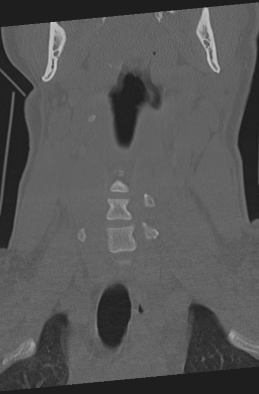 Axis peg fracture (type 3) and atlas lateral mass (type 4) fracture (Radiopaedia 37474-39324 Coronal bone window 8).png