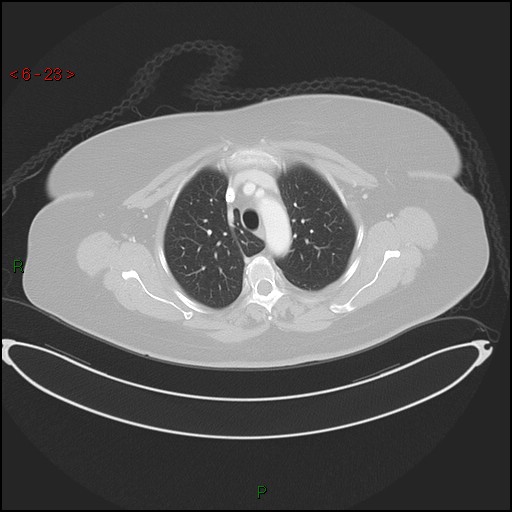 Azygos fissure and lobe (Radiopaedia 47620-52278 Axial lung window 23).jpg