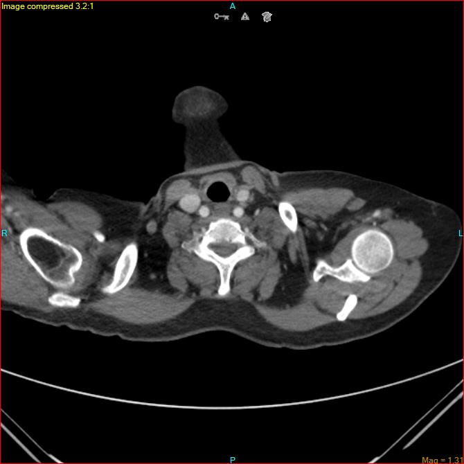 Azygos vein aneurysm (Radiopaedia 77824-90130 B 3).jpg