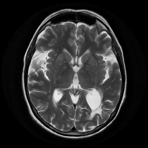 File:Balo concentric sclerosis (Radiopaedia 53875-59982 Axial T2 13).jpg