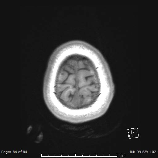 Balo concentric sclerosis (Radiopaedia 61637-69636 Axial T1 84).jpg