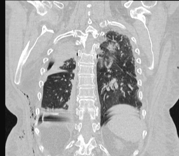 Barotrauma due to mechanical ventilation (Radiopaedia 28079-28336 Coronal lung window 72).jpg