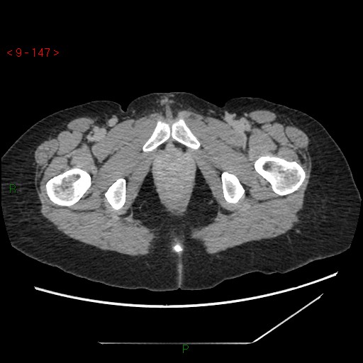 File:Bartholin gland cyst (Radiopaedia 54904-61181 Axial C+ delayed 37).jpg
