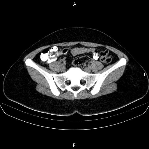 Bartholin gland cyst (Radiopaedia 62635-70930 Axial non-contrast 22).jpg