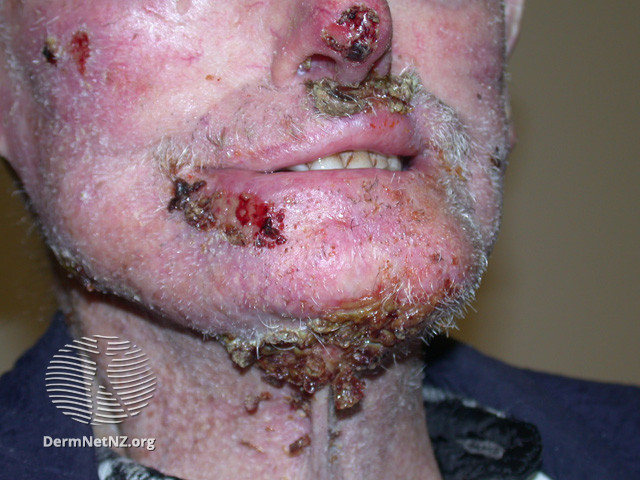 File:Basal cell carcinoma affecting the face (DermNet NZ lesions-bcc-face-1230).jpg