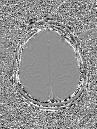 Base of skull chondrosarcoma (Radiopaedia 30410-31070 Axial SWI Phase 47).jpg