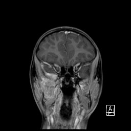 Base of skull rhabdomyosarcoma (Radiopaedia 32196-33142 I 26).jpg