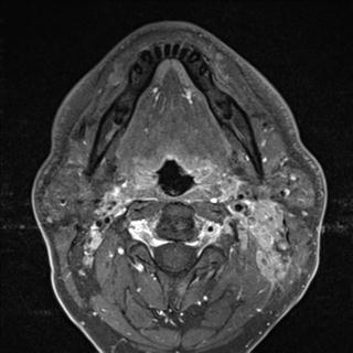 File:Base of tongue squamous cell carcinoma (Radiopaedia 31174-31884 Axial T1 C+ fat sat 20).jpg