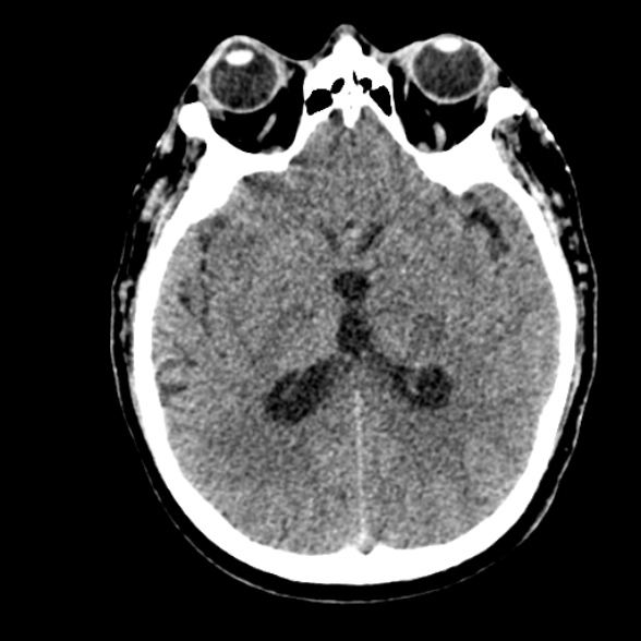 Basilar artery thrombosis (Radiopaedia 53351-59352 Axial non-contrast 63).jpg