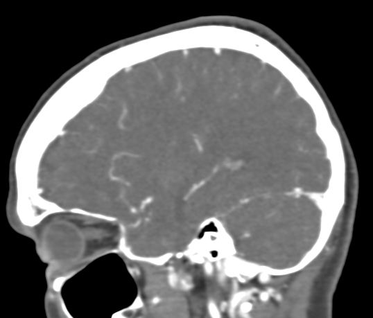 Basilar tip aneurysm with coiling (Radiopaedia 53912-60086 C 36).jpg