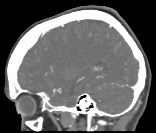 Basilar tip aneurysm with coiling (Radiopaedia 53912-60086 C 97).jpg