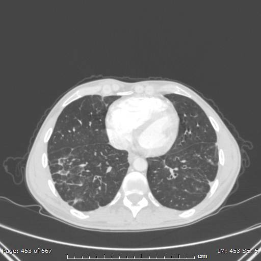 File:Behçet disease (Radiopaedia 44247-47889 Axial lung window 62).jpg