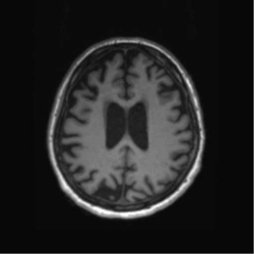 Behavioral variant frontotemporal dementia and late onset schizophrenia (Radiopaedia 52197-58083 Axial T1 30).png