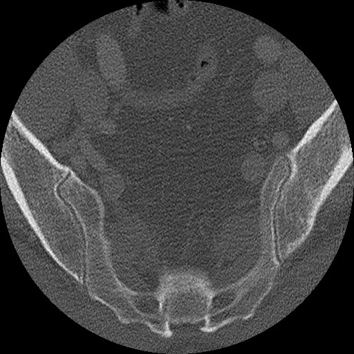 Benign post-traumatic pseudopneumoperitoneum (Radiopaedia 71199-81495 Axial bone window 302).jpg
