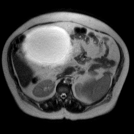 File:Benign seromucinous cystadenoma of the ovary (Radiopaedia 71065-81300 Axial T2 10).jpg