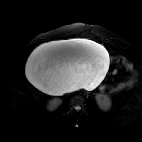 File:Benign seromucinous cystadenoma of the ovary (Radiopaedia 71065-81300 T2 SPAIR 26).jpg