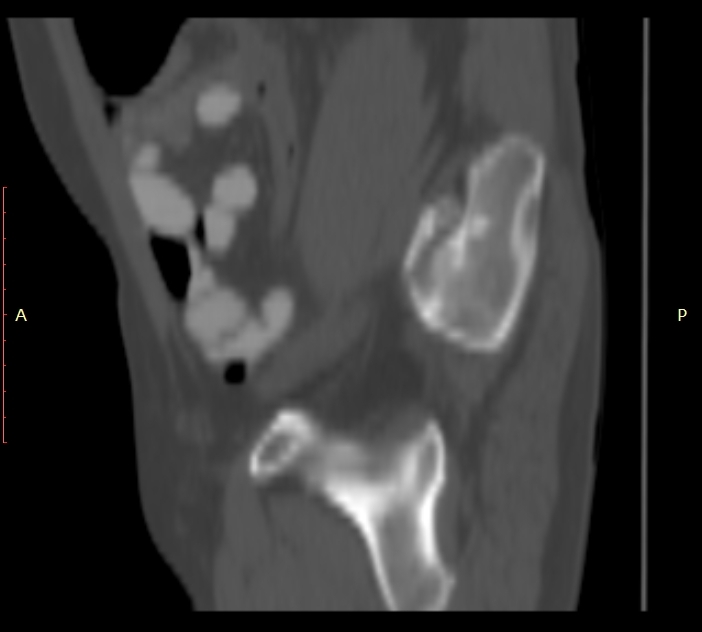 Bertolotti syndrome (Radiopaedia 58974-66235 Sagittal bone window 54).jpg