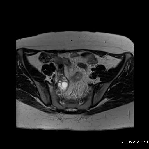 File:Bicornuate uterus- on MRI (Radiopaedia 49206-54297 Axial T2 3).jpg