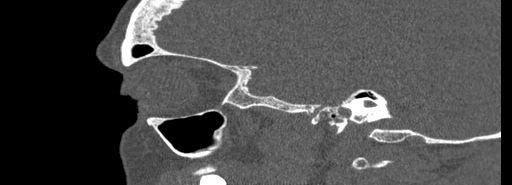 File:Bilateral Ectopic Infraorbital Nerves (Radiopaedia 49006-54084 Sagittal bone window 9).jpg