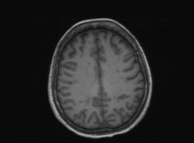Bilateral PCA territory infarction - different ages (Radiopaedia 46200-51784 Axial T1 188).jpg