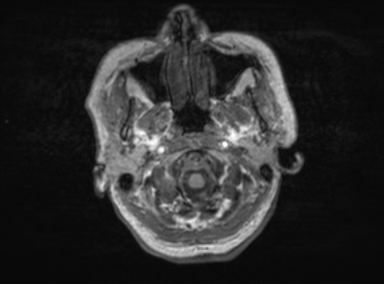 File:Bilateral PCA territory infarction - different ages (Radiopaedia 46200-51784 Axial T1 352).jpg