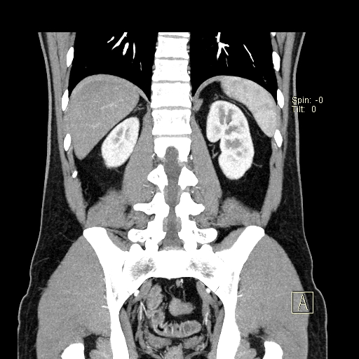 File:Bilateral accessory renal arteries with mild pelvi-ureteric junction (PUJ) obstruction (Radiopaedia 66357-75596 B 43).jpg