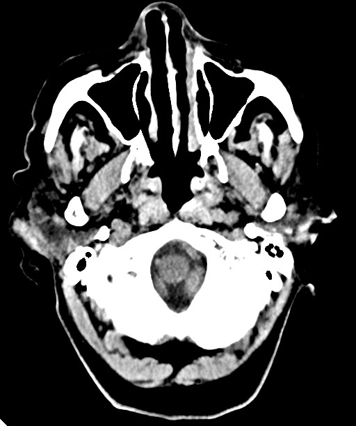 Bilateral acute on chronic subdural hematomas (Radiopaedia 78466-91146 Axial non-contrast 11).jpg