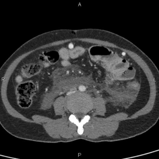 Bilateral adrenal gland hyperenhancement in pancreatitis (Radiopaedia 86642-102753 E 67).jpg