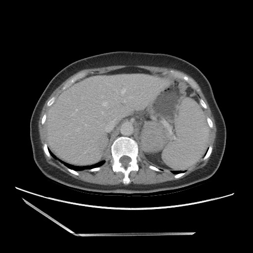 Bilateral adrenal granulocytic sarcomas (chloromas) (Radiopaedia 78375-91007 A 29).jpg