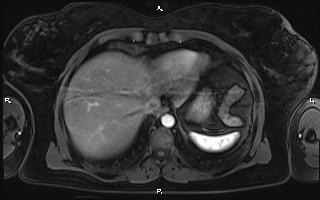 Bilateral adrenal myelolipoma (Radiopaedia 63058-71537 Axial T1 C+ fat sat 15).jpg