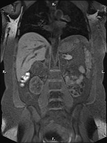 Bilateral adrenal myelolipoma (Radiopaedia 63058-71537 Coronal T1 fat sat 47).jpg