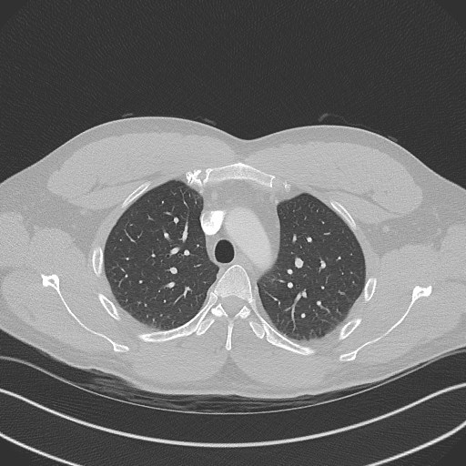 File:Bilateral atelectasis (Radiopaedia 48666-53675 Axial lung window 29).jpg