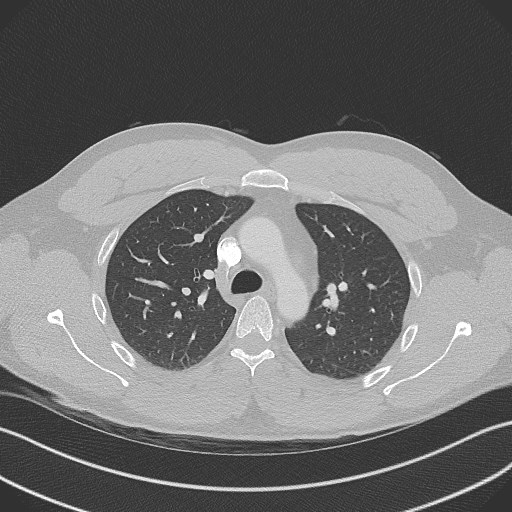 File:Bilateral atelectasis (Radiopaedia 48666-53675 Axial lung window 37).jpg