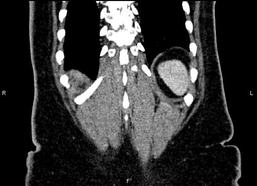 Bilateral benign adrenal adenomas (Radiopaedia 86912-103124 D 59).jpg