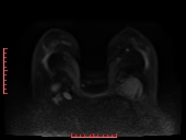 File:Bilateral breast implant rupture (Radiopaedia 24761-25027 DWI 17).jpg