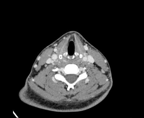 Bilateral carotid body tumors (Radiopaedia 61841-69870 Axial Post contrast 71).jpg