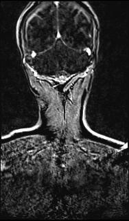 Bilateral carotid body tumors and right glomus jugulare tumor (Radiopaedia 20024-20060 MRA 140).jpg