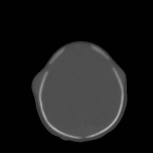 File:Bilateral cephalohematomas and subdural hematomas (Radiopaedia 26778-26929 Axial bone window 24).jpg