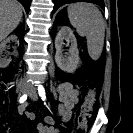 File:Bilateral delayed nephrogram from renal artery stenosis (Radiopaedia 47681-52362 B 16).png