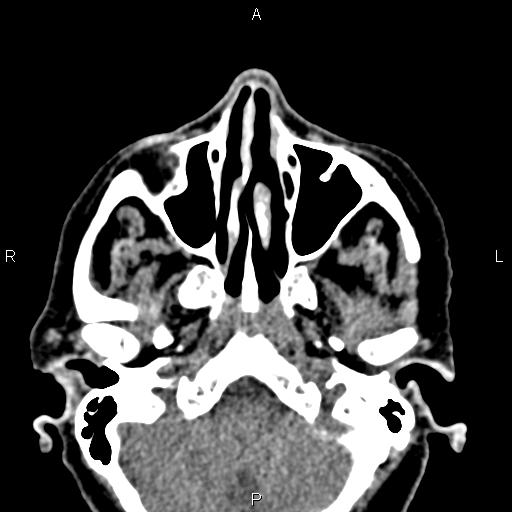 Bilateral enlargement of lacrimal glands - sarcoidosis (Radiopaedia 62627-70921 Axial non-contrast 18).jpg