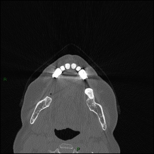 File:Bilateral frontal mucoceles (Radiopaedia 82352-96454 Axial bone window 284).jpg