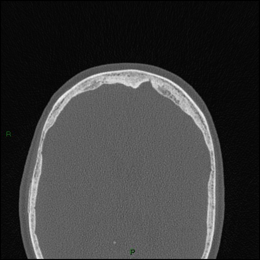 Bilateral frontal mucoceles (Radiopaedia 82352-96454 Axial bone window 49).jpg