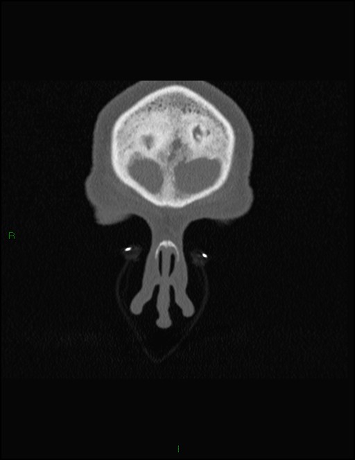Bilateral frontal mucoceles (Radiopaedia 82352-96454 Coronal 37).jpg