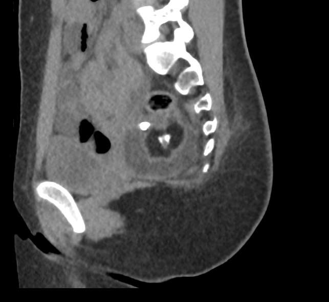 Bilateral mature cystic ovarian teratoma (Radiopaedia 88821-105592 D 42).jpg