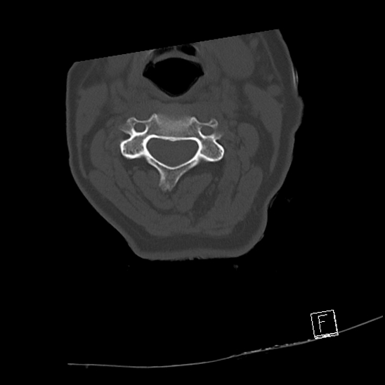 Bilateral occipital condyle fractures (type 3) (Radiopaedia 87672-104086 Axial bone window 32).jpg