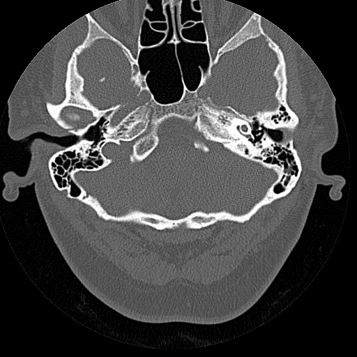 File:Bilateral ossifications of the external auditory canal (Radiopaedia 15233-15076 Axial bone window 11).jpg
