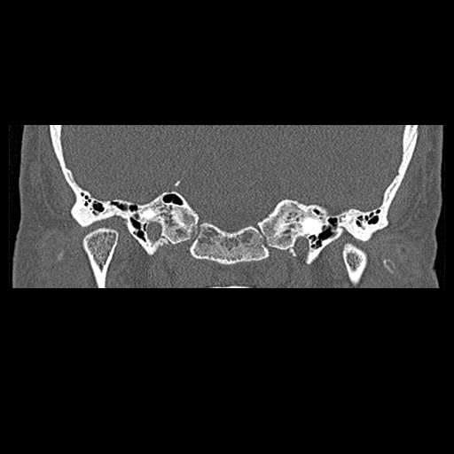 File:Bilateral ossifications of the external auditory canal (Radiopaedia 15233-15076 Coronal bone window 5).jpg