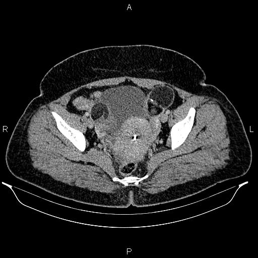 Bilateral ovarian dermoid cysts (Radiopaedia 85785-101603 A 93).jpg