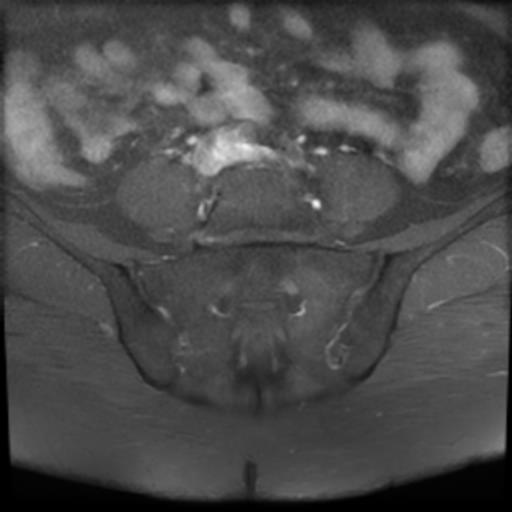 File:Bilateral ovarian dermoid cysts (Radiopaedia 90152-107338 Axial T1 C+ fat sat 1).jpg