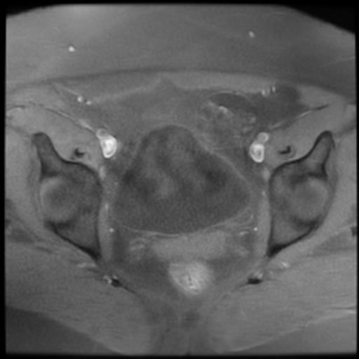 File:Bilateral ovarian dermoid cysts (Radiopaedia 90152-107338 Axial T1 fat sat 14).jpg